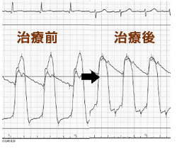 図2 治療前後の大動脈と左室の圧格差