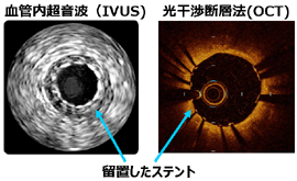 ステントを留置した部位の血管内超音波と光干渉断層法で観察した画像