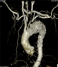 遠位弓部大動脈瘤ステントグラフト内挿術
