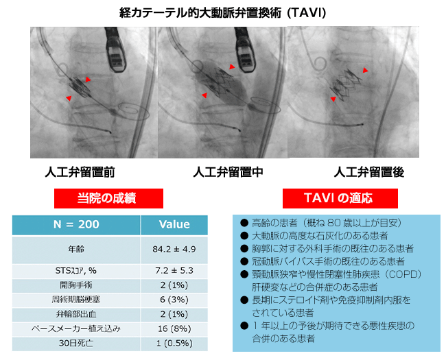 経大腿アプローチ,経心尖アプローチ,経カテーテル的大動脈弁置換術 (TAVI)
